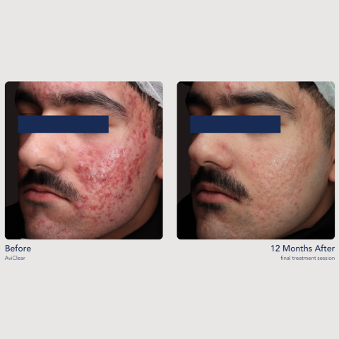 Before and After