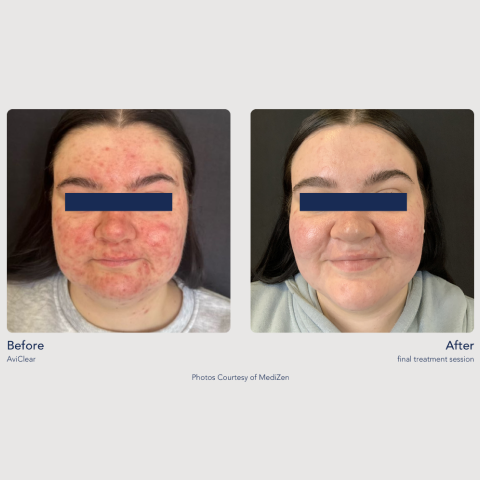 Before and After