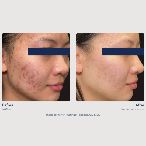 Before and After